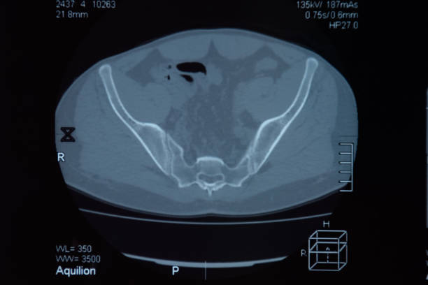 mri sacroiliac 관절. 강직성 척추 관절염 환자의 연구. - x ray image x ray back low 뉴스 사진 이미지