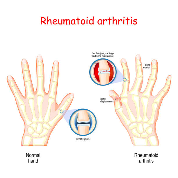 ревматоидный артрит - color enhanced stock illustrations