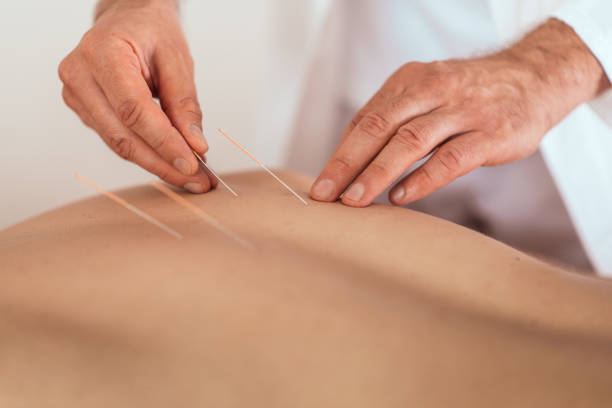 istock Man receiving acupuncture treatment 1165727194