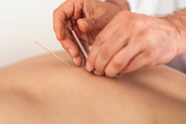 istock Man receiving acupuncture treatment 1165727196