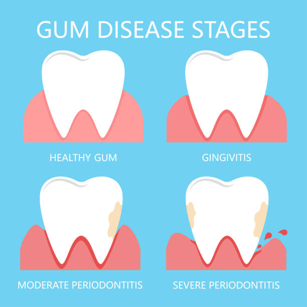 stages of gum disease Stomatological concept. The stages of gum disease, the stage of development of dental periodontitis. Vector illustration. tooth enamel stock illustrations