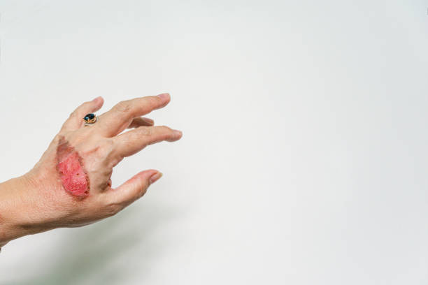 17.400  Fotos, Bilder und lizenzfreie Bilder zu Haut Verbrannt - iStock