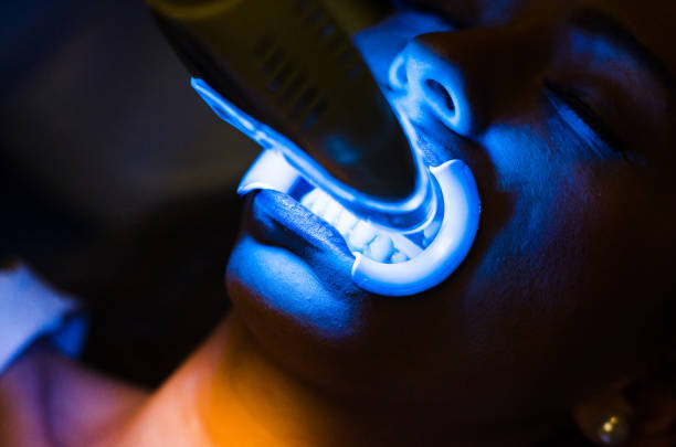 Face of a woman in a dental clinic doing teeth whitening . stock photo