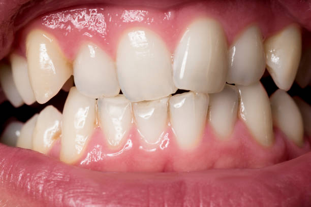 istock Close up shot of human uneven teeth with some tartar. 1166007781