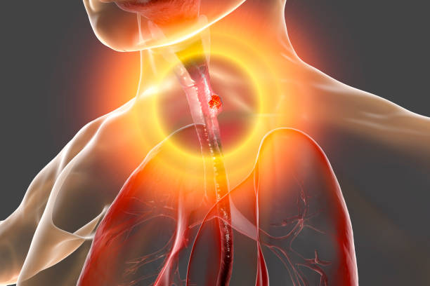 cancro esofageo, illustrazione - dysphagia foto e immagini stock