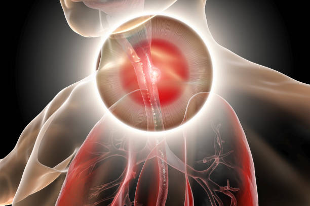 cancro esofageo, illustrazione - dysphagia foto e immagini stock