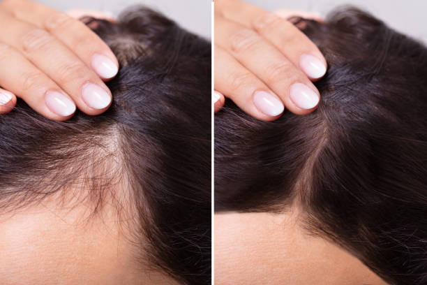 Before And After Hair Loss Treatment Woman Before And After Hair Loss Treatment balding photos stock pictures, royalty-free photos & images