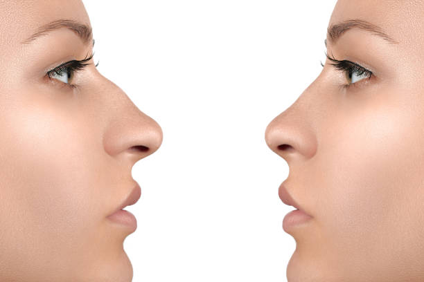 Female face before and after cosmetic nose surgery stock photo