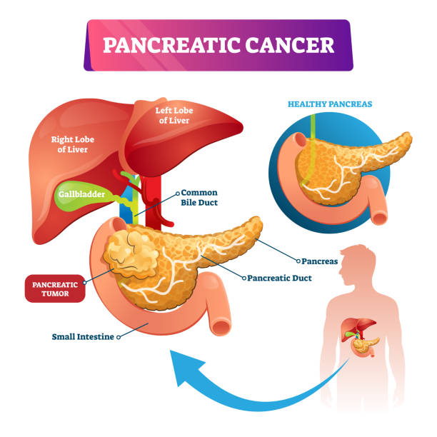 Pancreatic cancer vector illustration. Labeled ill stomach oncology disease vector art illustration