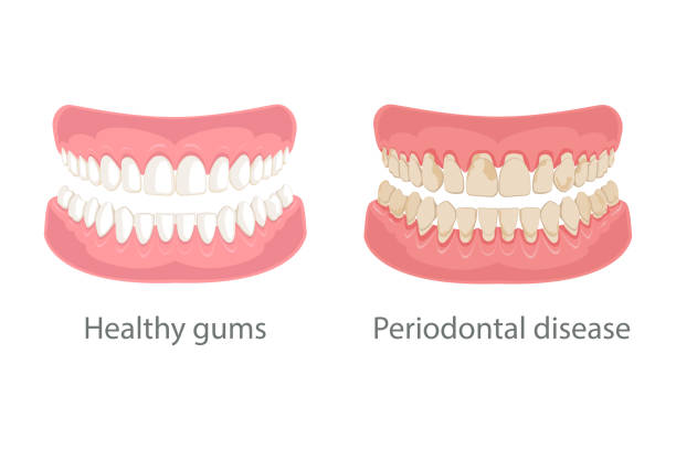 zahnfleischbehandlung, zahnfleischerkrankung - gums stock-grafiken, -clipart, -cartoons und -symbole