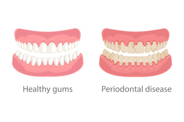 ilustrações de stock, clip art, desenhos animados e ícones de gum treatment, gum disease - gums