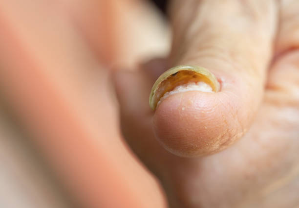 istock advanced nail fungal disease 1166277384