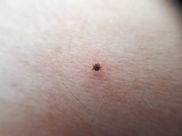 istock sucking tick, ixodes ricinus, sucking on a human 1166389684