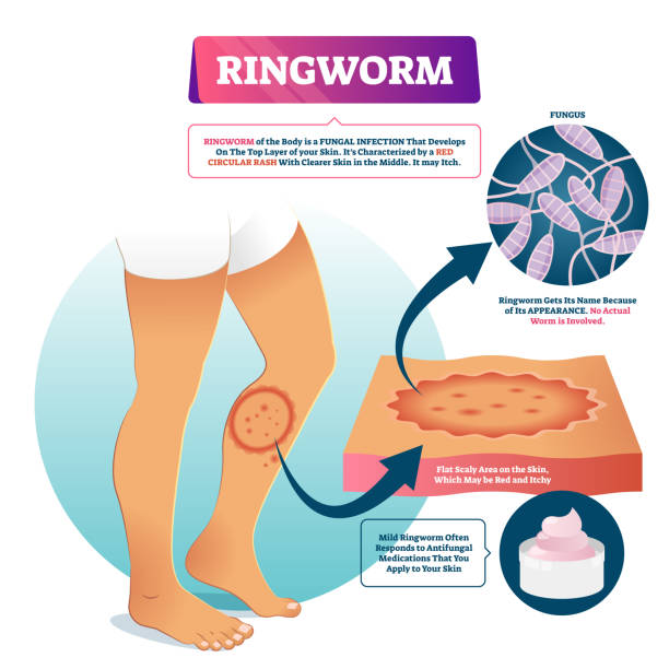 Ringworm vector illustration. Labeled fungal skin infection example scheme. Ringworm vector illustration. Labeled fungal skin infection example scheme. Educational diagram with dermatology problem diagnosis. Isolated anatomical closeup with appearance, causes and symptoms. tinea stock illustrations