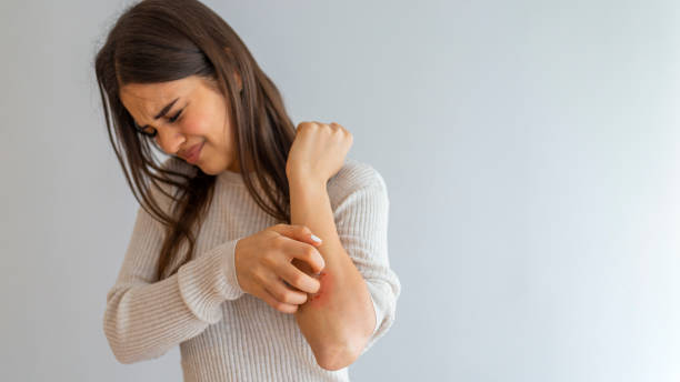 Dermatitis Young woman scratching arm from having itching on white background. Cause of itchy skin include insect bites, dermatitis, food/drugs allergies or dry skin. Health care concept. Close up. photo psoriasis stock pictures, royalty-free photos & images