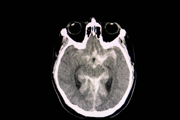 Brain Ct scan showing acute subarachnoid hemorrhage A CT scan of the brain of a patient with traffic accident showing acute subarachnoid hemorrhage hematoma images stock pictures, royalty-free photos & images