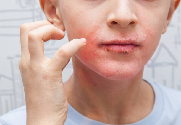 istock Boy scratching his face. Human skin, presenting an allergic reaction, allergic rash on face and lips. 1166603208