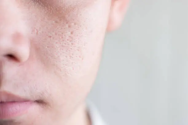 Close up image of half face Asia male with wide pores skin problem