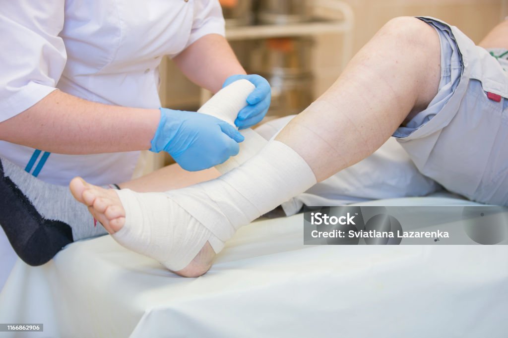 Nurse bandages the leg. Fracture of human lower limbs. Treatment of broken bones. Impose a gypsum. Patient surgical department. The doctor's hands tighten the bandage on his leg Wound Stock Photo