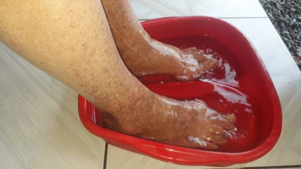 pediküre tun fingernägel mit ringwurm - fungus toenail human foot onychomycosis stock-fotos und bilder