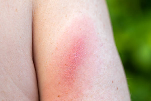 lyme disease - lyme disease imagens e fotografias de stock