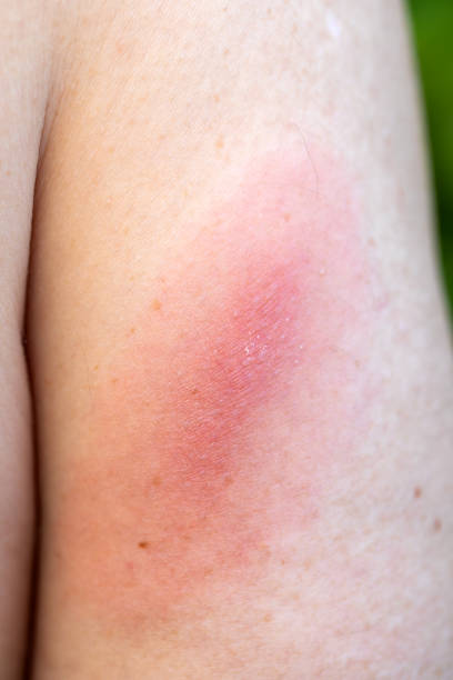 lyme disease - lyme disease imagens e fotografias de stock