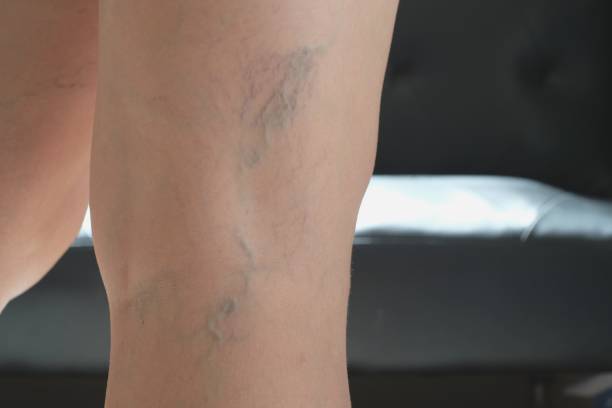 close-up spataderen in de benen - woman legs veins stockfoto's en -beelden