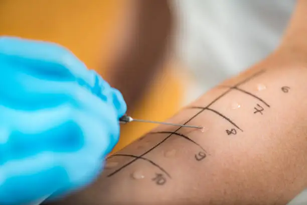 Immunologist Doing Skin Prick Allergy Test on a Woman’s Arm