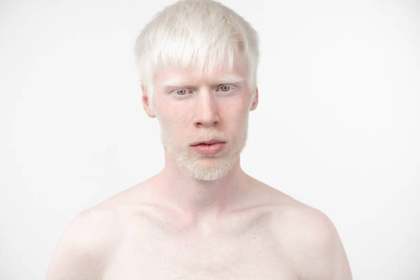 portret-van-een-albino-man-in-studio-gekleed-t-shirt-ge%C3%AFsoleerd-op-een-witte-achtergrond.jpg?s=612x612&w=0&k=20&c=HEvHSiF_SVUZqyjokhzwdgJQqEqxWHeos0PXq2Ngtl0=