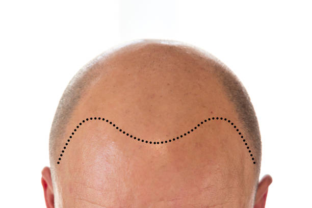 View of bald man's head View of bald man's head with hair loss and receding line skinhead haircut stock pictures, royalty-free photos & images