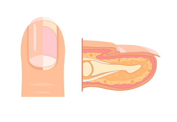 anatomia ludzkiego paznokcia. schemat medyczny struktury wewnętrznego przekroju palców. koncepcja infografiki wektora izolowana na białym tle - computer language illustrations stock illustrations