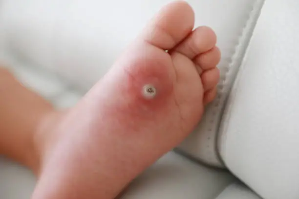 A wart on the foot of a little boy with a white dot left from Compound-W treatment band-aid. Foot disease in little kids. Summer illness. Summer wart.