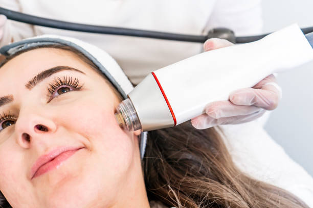 radio-frequenz microneedling maschine handstück auf der wange einer frau gesicht während einer schönheit haut straffung behandlung. - handpiece stock-fotos und bilder