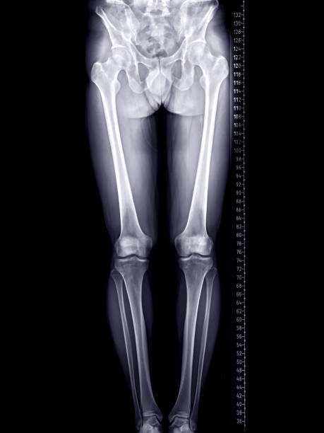 scanogram of lower limb or X-ray image of total lower extremity with scale. stock photo