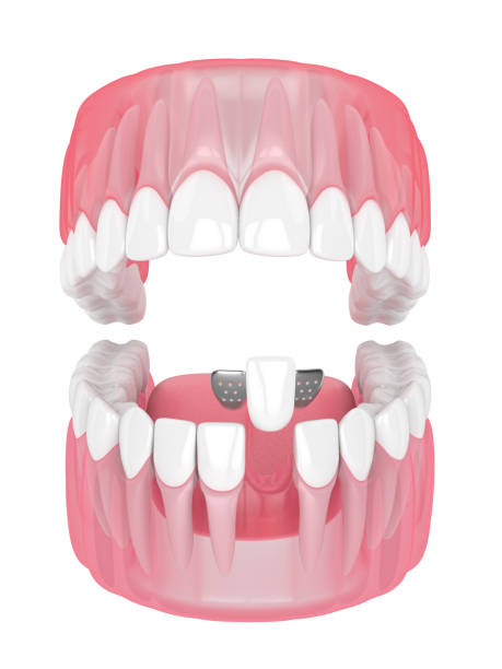 istock 3d render of jaw with teeth and maryland bridge 1167551653