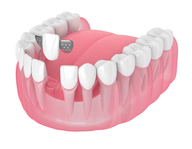 istock 3d render of jaw with teeth and maryland bridge 1167551656