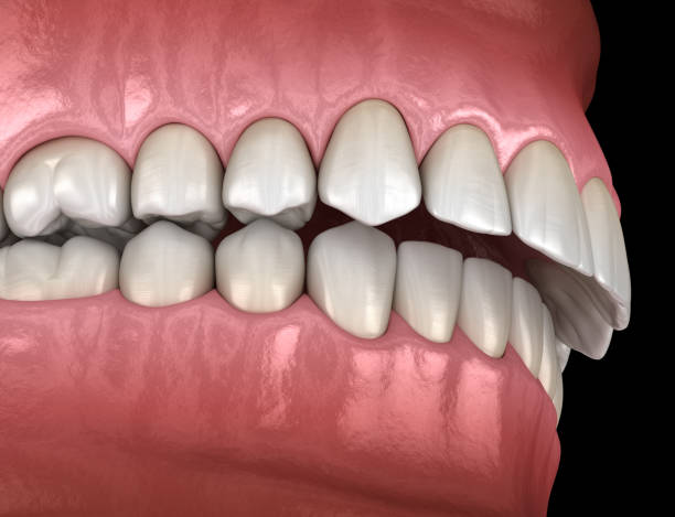 istock Overbite dental occlusion ( Malocclusion of teeth ). Medically accurate tooth 3D illustration 1167568096