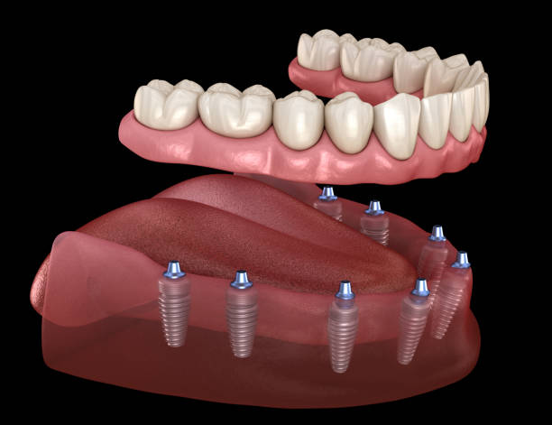 mandibular prosthesis all on 8 system supported by implants. medically accurate 3d illustration of human teeth and dentures concept - implantat imagens e fotografias de stock