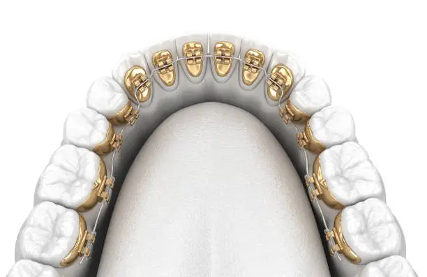 Lingual braces system. 3D illustration concept of golden braces