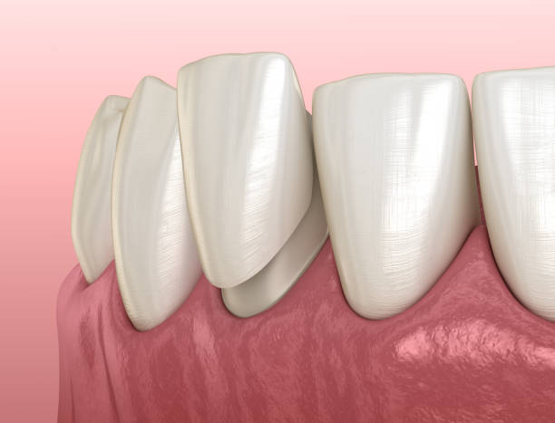 Mandibular Veneer installation procedure over lateral incisor. Medically accurate tooth 3D illustration Mandibular Veneer installation procedure over lateral incisor. Medically accurate tooth 3D illustration teeth bonding stock pictures, royalty-free photos & images