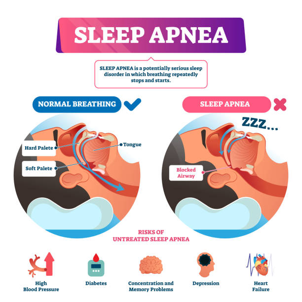 2,626 Snoring Illustrations & Clip Art - iStock | Sleep apnea, Sleep, Insomnia