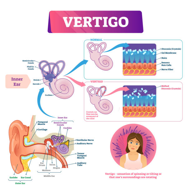 illustrations, cliparts, dessins animés et icônes de illustration de vecteur de vertigo. système de problème d'oreille vestibulaire médicale étiqueté. - vertige