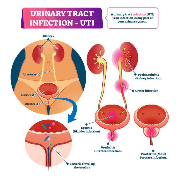 Urinary tract infection or UTI vector illustration. Labeled medical scheme. vector art illustration