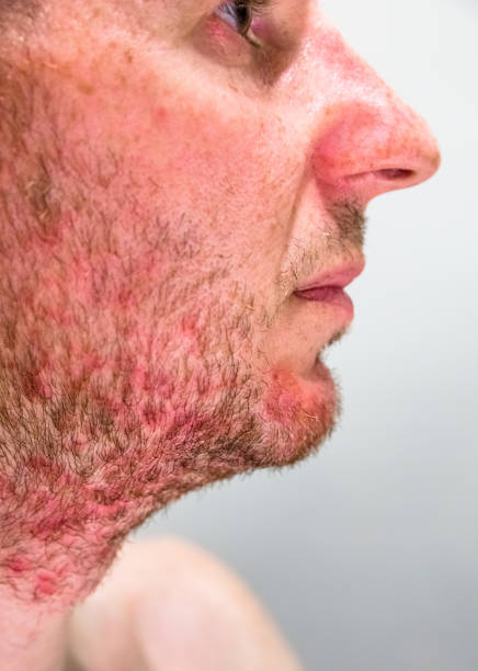 Detail of man's chin with seborrheic dermatitis in the beard area