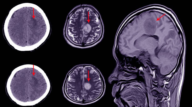 tomografía computarizada del cerebro de un paciente con antecedentes de lesión leve en la cabeza que muestra un hematoma subdural subagudo grande - computed fotografías e imágenes de stock