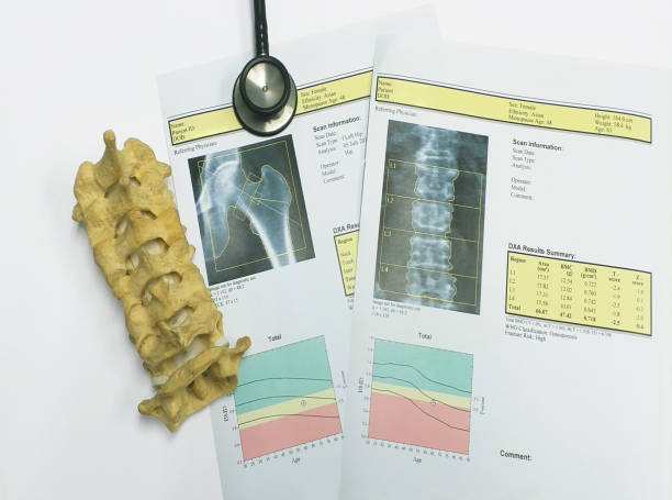 istock bone density hip and lumbarspine Result Osteoporosis 1167772362