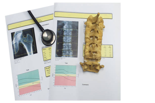 istock bone density hip and lumbarspine Result Osteoporosis 1167772681