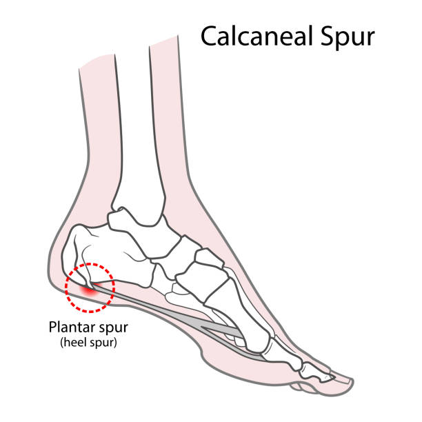 plantarsporn (kalkanealsporn). menschliche fußknochen. vektor-illustration isoliert auf weißem hintergrund - fersenbein stock-grafiken, -clipart, -cartoons und -symbole