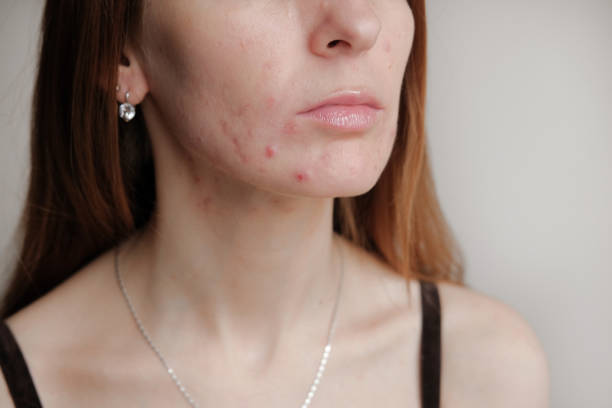 皮膚に問題がある女性。若い肌に十代のにきび。にきびを除去するためのツール。 - にきび ストックフォトと画像