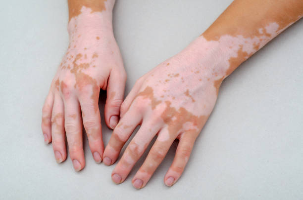 istock Vitiligo on skin of hands. 1167995289